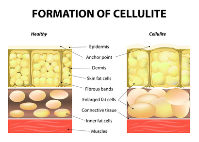 Carolas Kosmetikstudio - Cellulite Behandlung Carolas Kosmetikstudio - Cellulite Behandlung